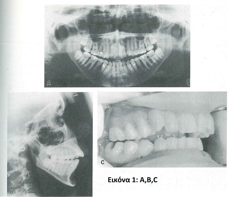 juvenile chronic arthritis 1